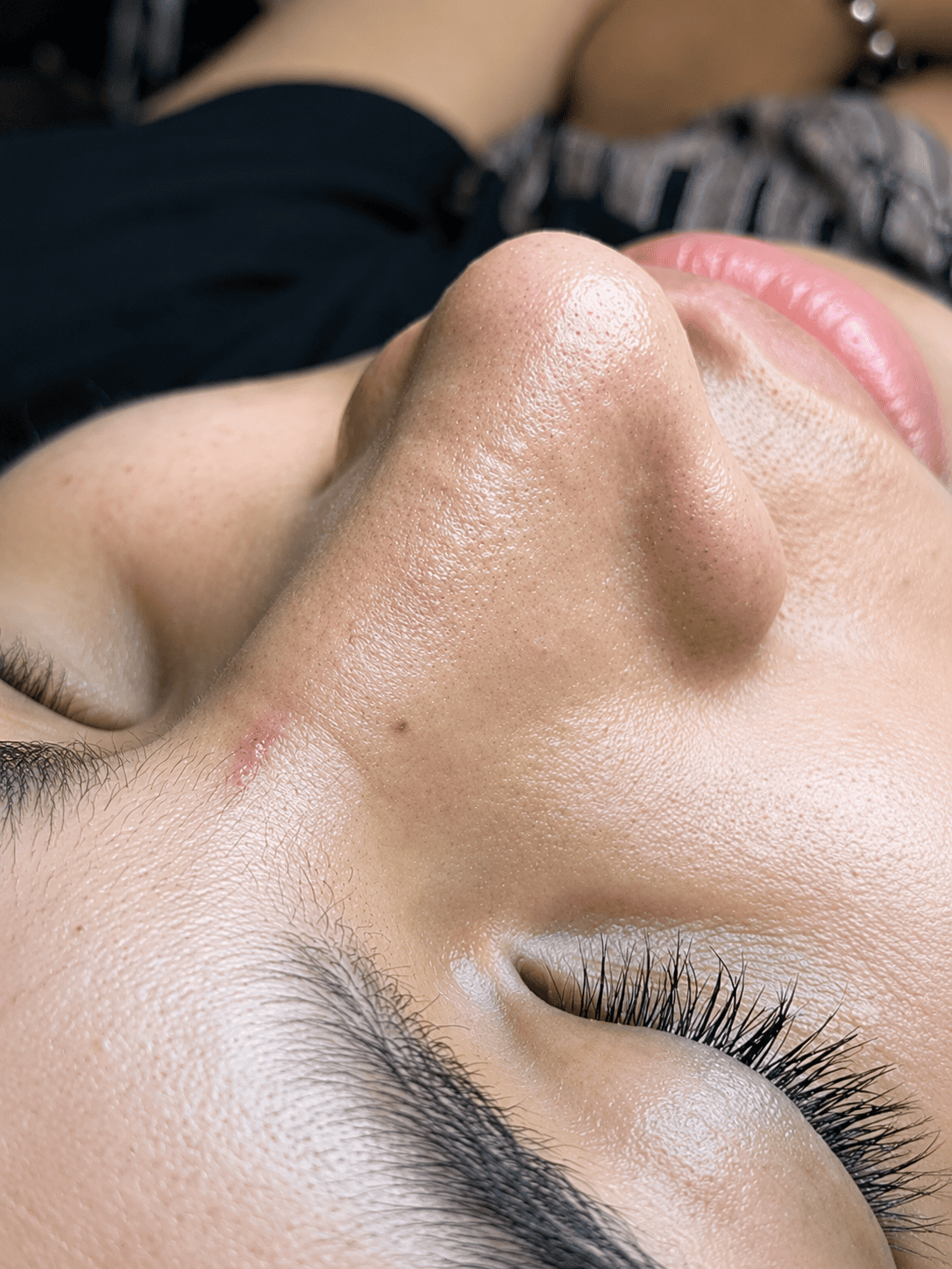 Después — Limpieza Facial Profunda