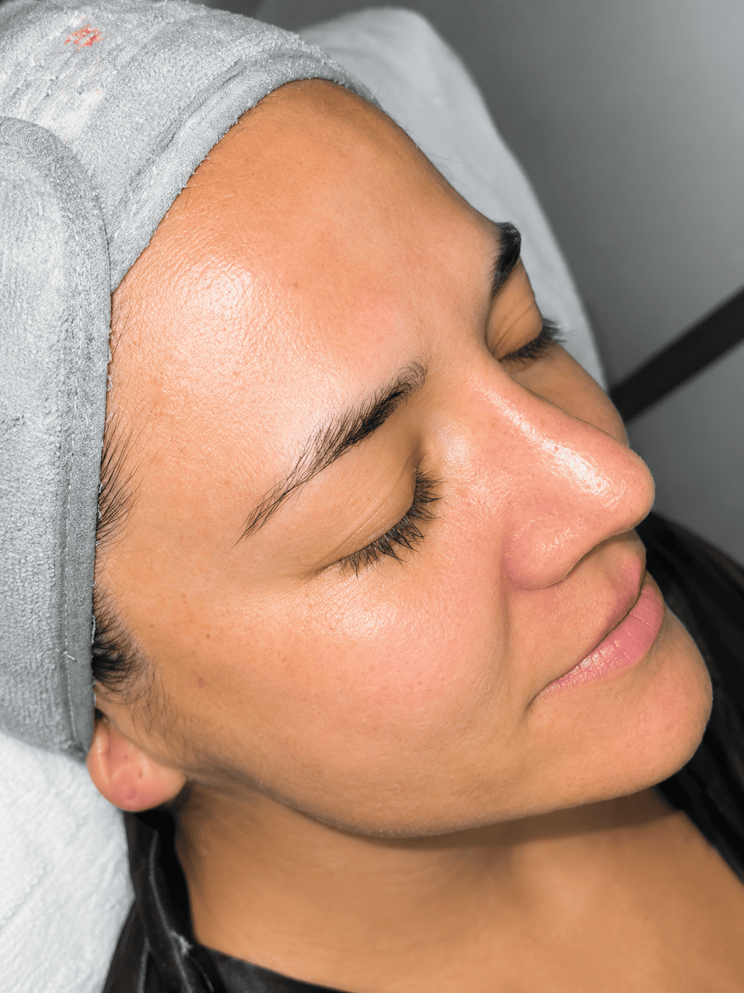 Después — Hidratación Facial Profunda