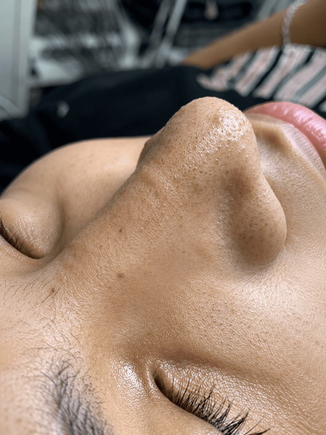 Antes — Limpieza Facial Profunda