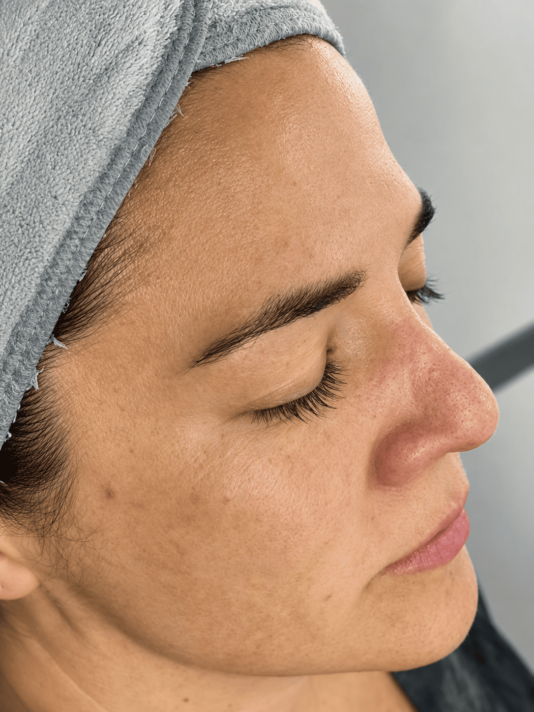 Antes — Hidratación Facial Profunda